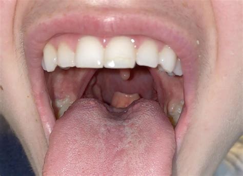 visible epiglottis in children